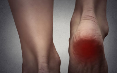 6 Ways You’re Hurting Your Heels [What to Do About It]