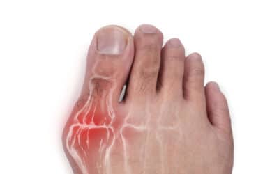 Lapiplasty: A Better Way to Do Bunion Surgery