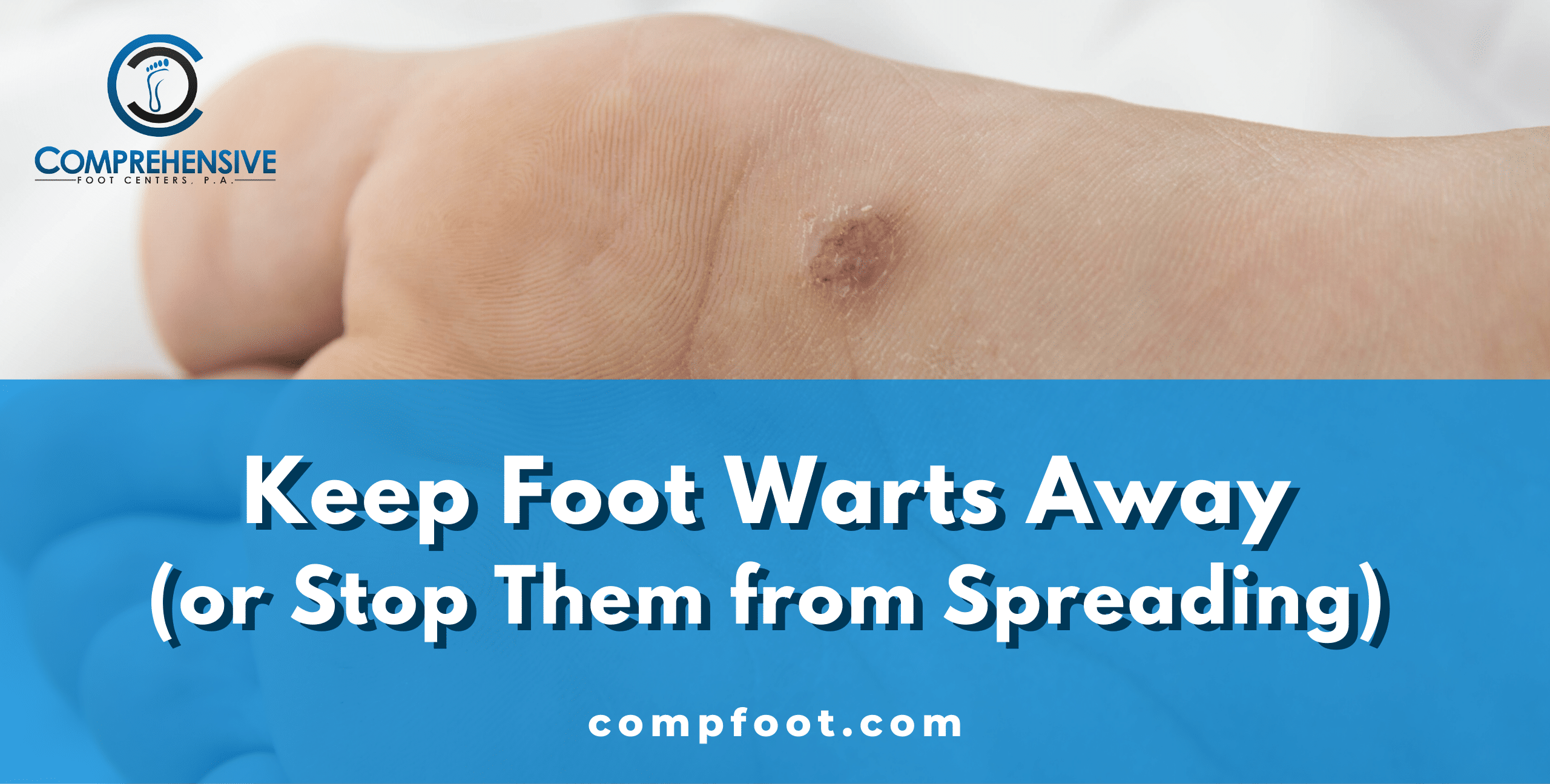 How To Keep Warts Away