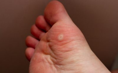 Keep Plantar Warts Away (or Stop Them from Spreading!)