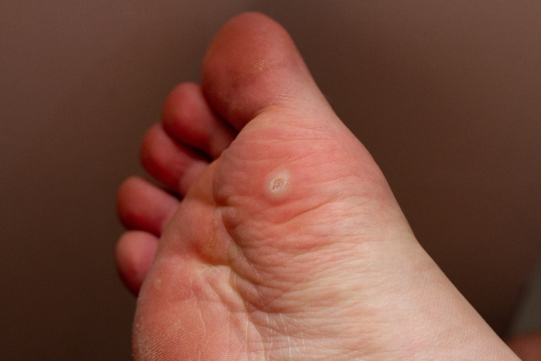 Foot wart not going away - Wart on foot not going away. Translation of 