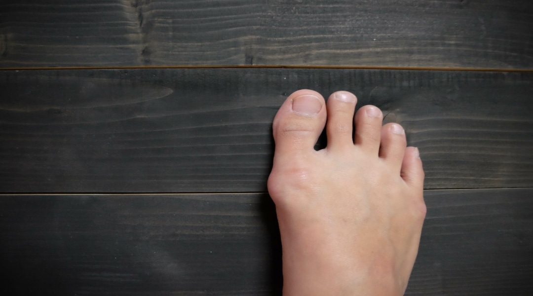 Bunions1 bunions