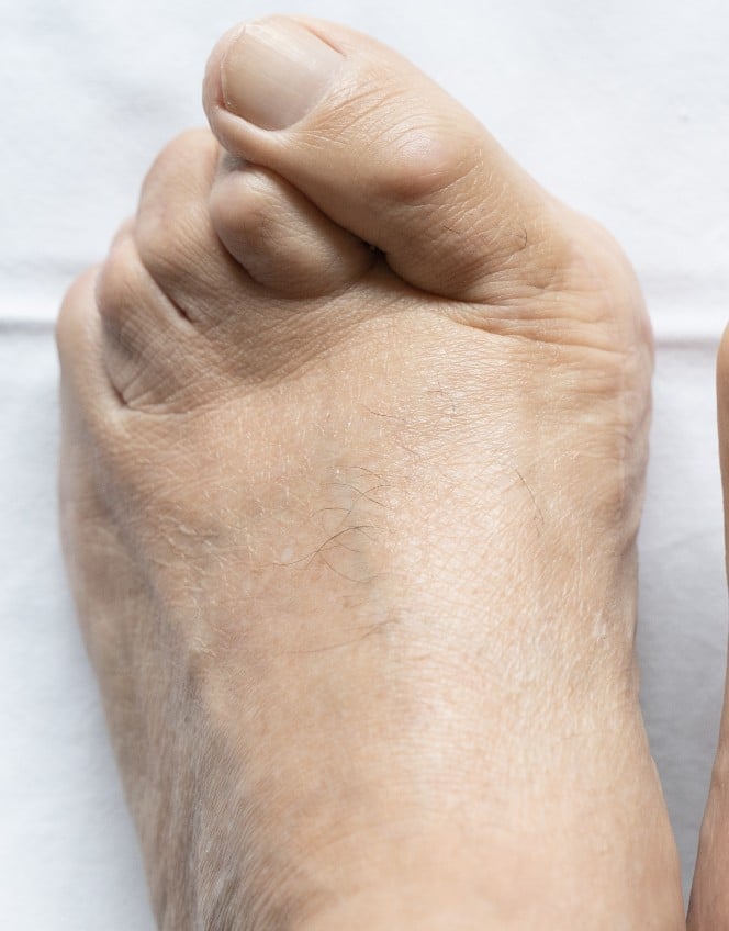 hammertoe on white cloth