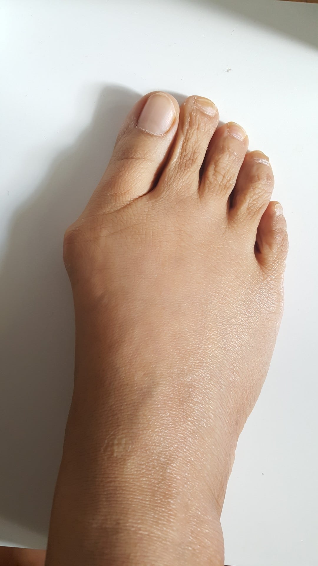 foot with bunion on white background