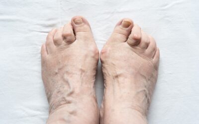 Hammertoe Treatment Options