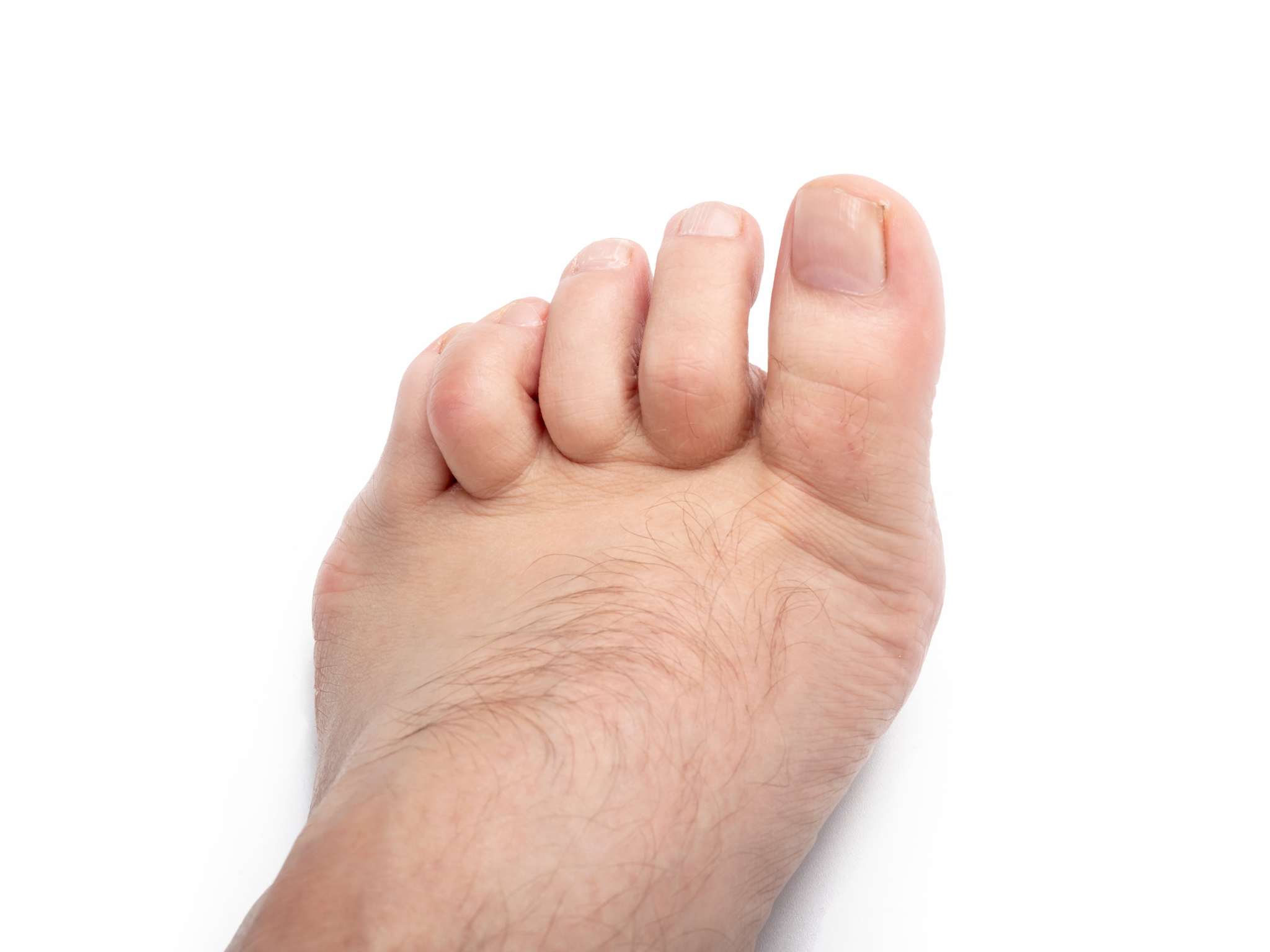 studio lighting. a human leg on a white background. The finger is strongly curved, deformed. Close-up.