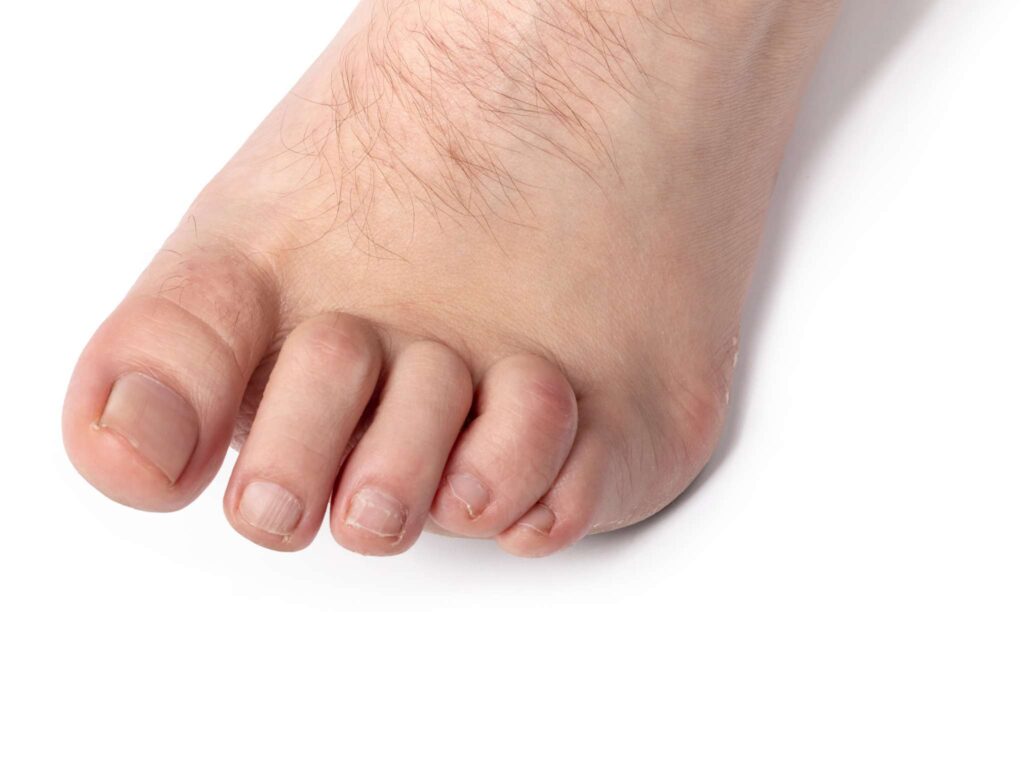 Hammertoe Treatment Options Comprehensive Foot Centers