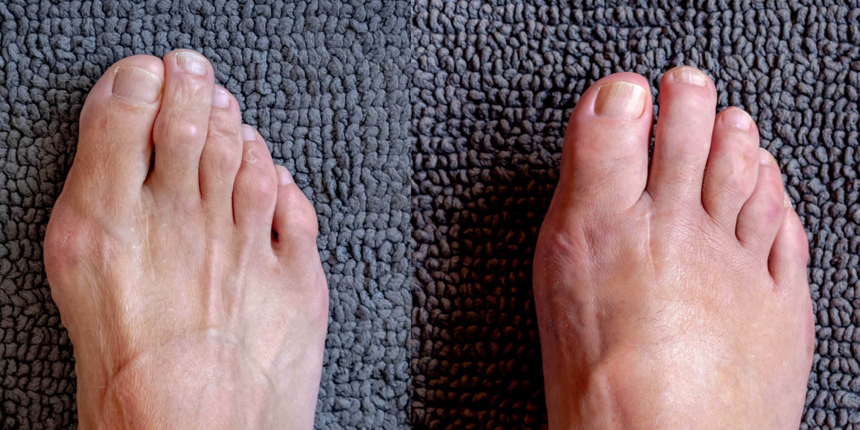 Before and after operation concept, Bare men's feet problem with a bunion (also referred to as hallux valgus or hallux abducto valgus) is often described as a bump on the side of the big toe.