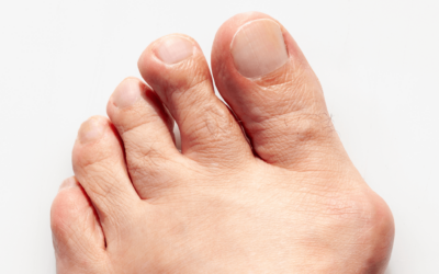 Is Bunion Surgery Worth it?